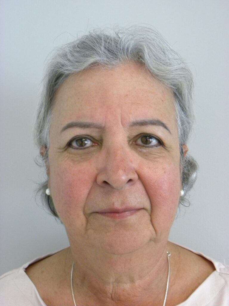 Blepharoplasty before and after - before