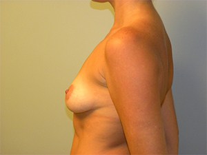Breast Augmentation before and after - before