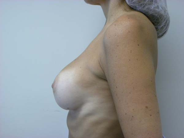 Breast Augmentation before and after - before