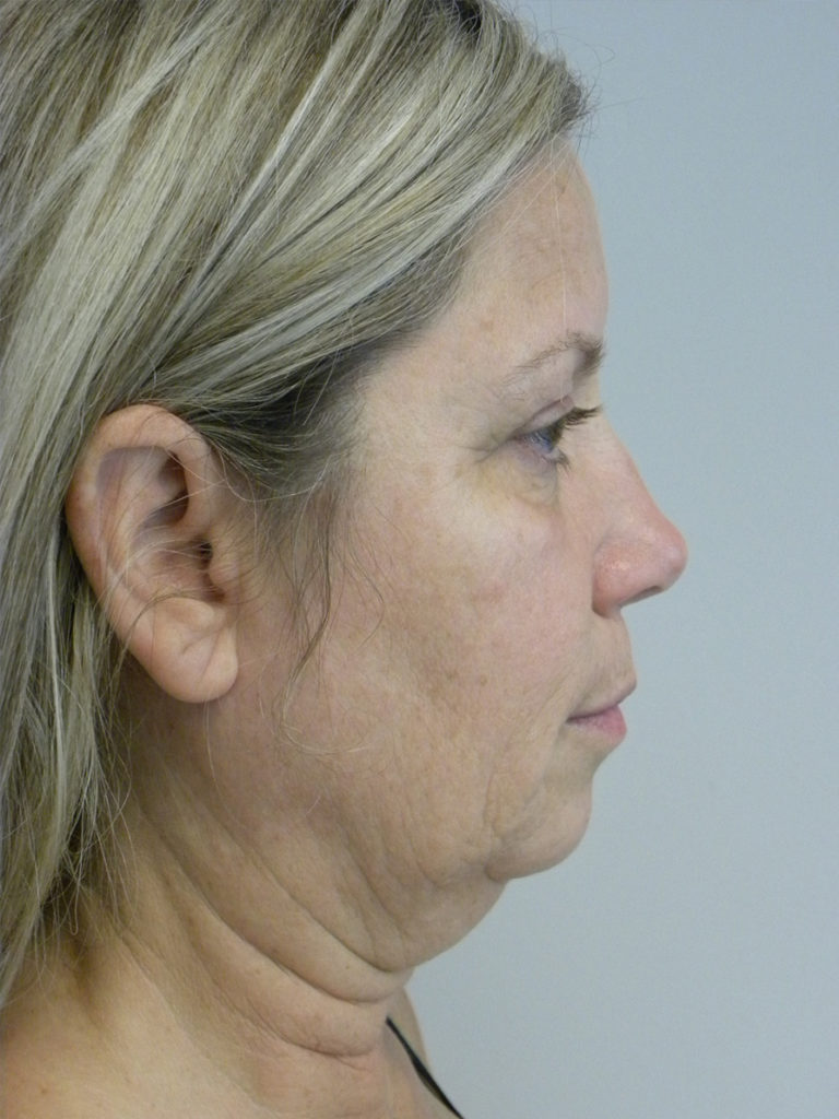 Facelift before and after - before
