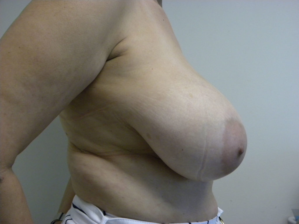 Breast Reduction before and after - before