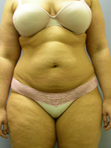 Liposuction before and after - before