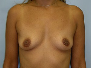 Breast Augmentation before and after - before