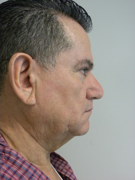 Facelift before and after - before