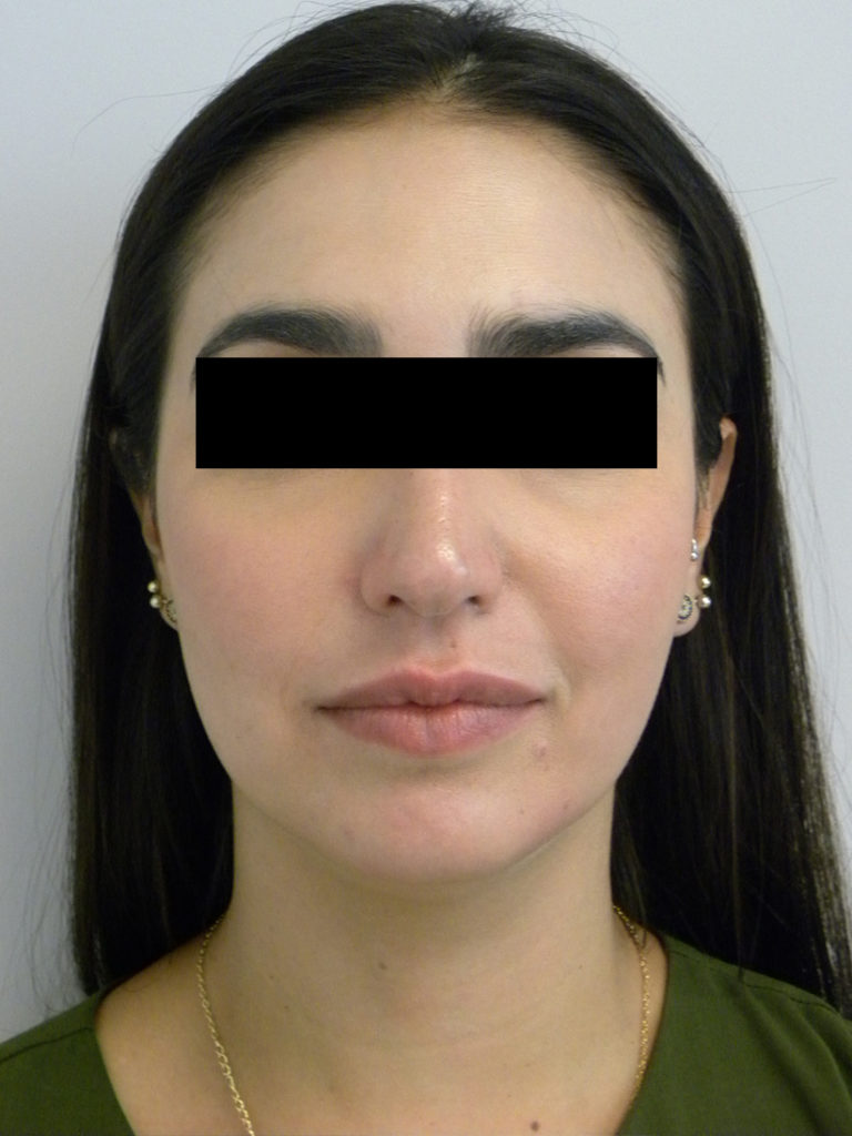 Chin before and after - before