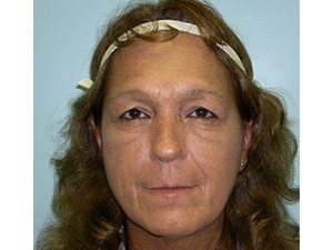 Blepharoplasty before and after - before