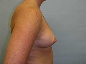 Breast Augmentation before and after - before