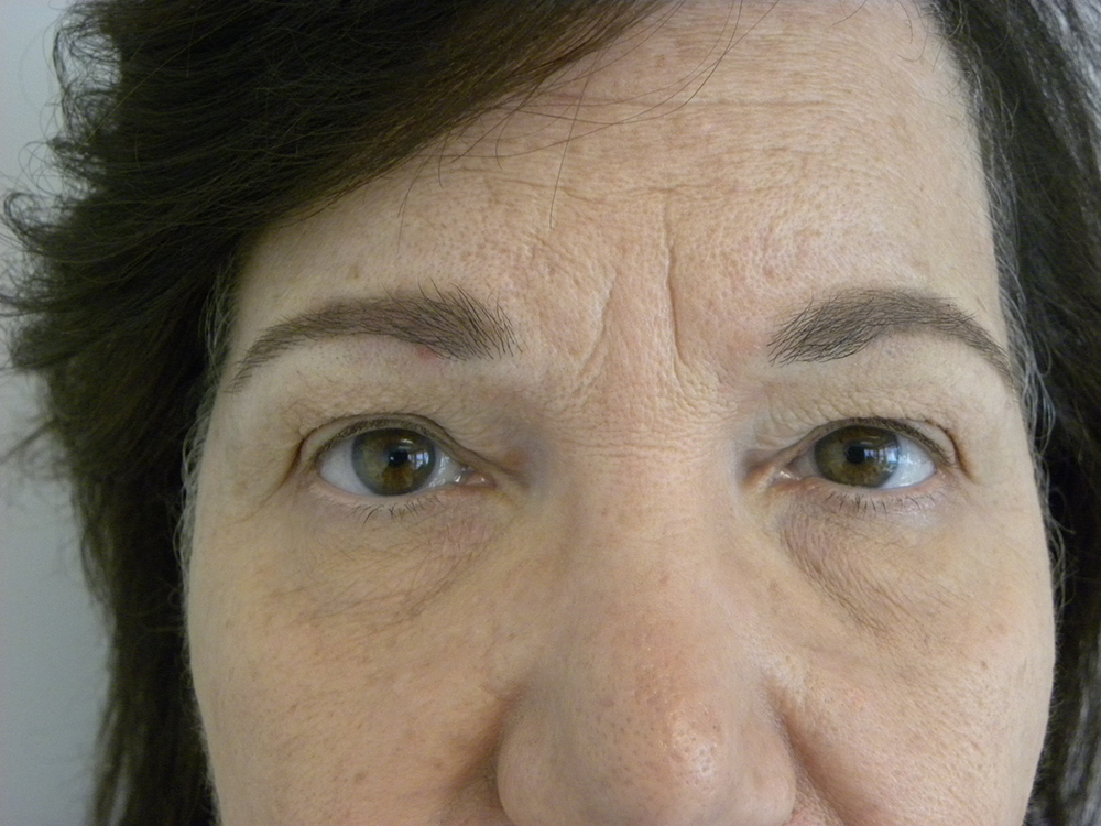 Blepharoplasty before and after - before
