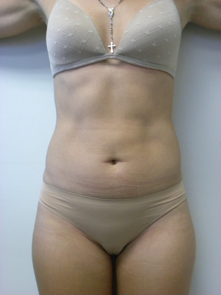 Liposuction before and after - before