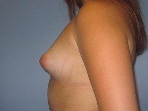 Breast Augmentation before and after - before