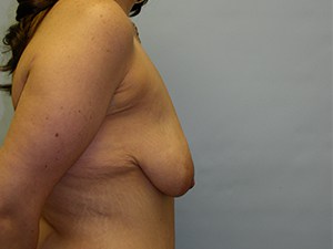 Breast Lift before and after - before