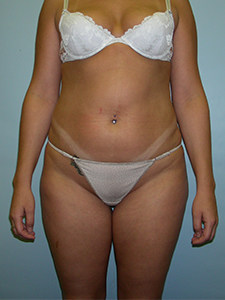 Liposuction before and after - before