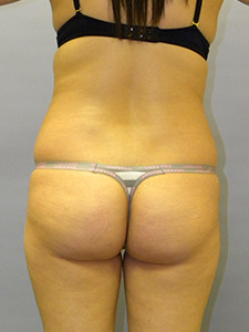 Liposuction before and after - before