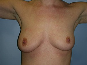 Breast Augmentation before and after - before