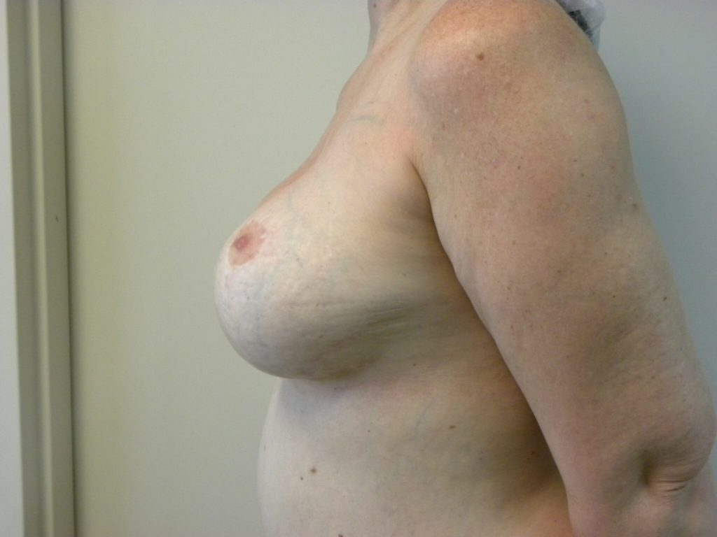 Breast Augmentation before and after - before