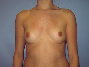 Breast Augmentation before and after - before