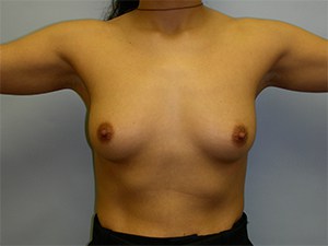 Breast Augmentation before and after - before