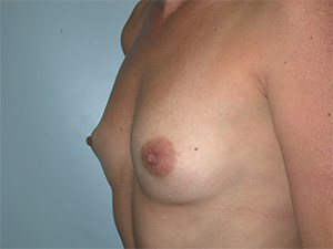 Breast Augmentation before and after - before
