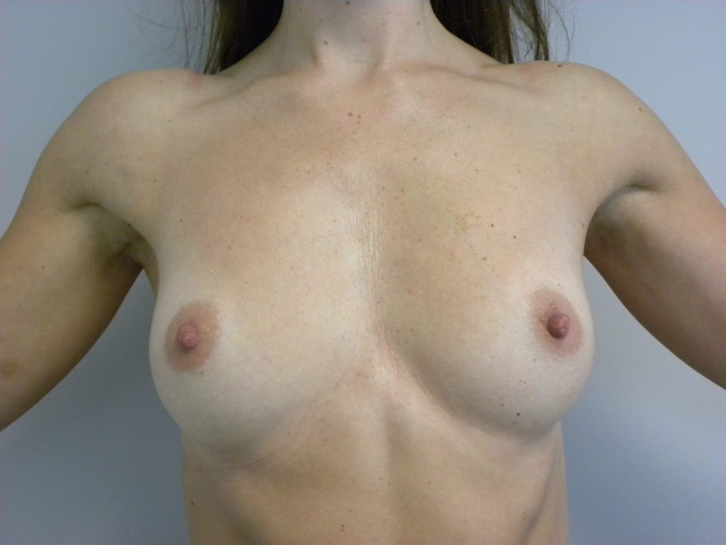 Breast Augmentation before and after - before