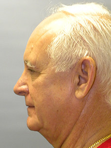 Facelift before and after - before