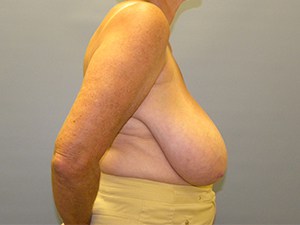 Breast Reduction before and after - before