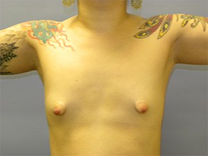 Breast Augmentation before and after - before