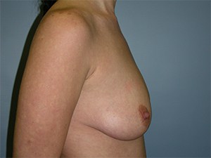 Breast Augmentation before and after - before