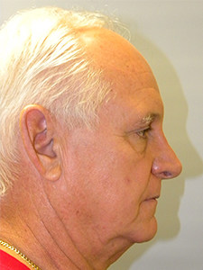 Facelift before and after - before