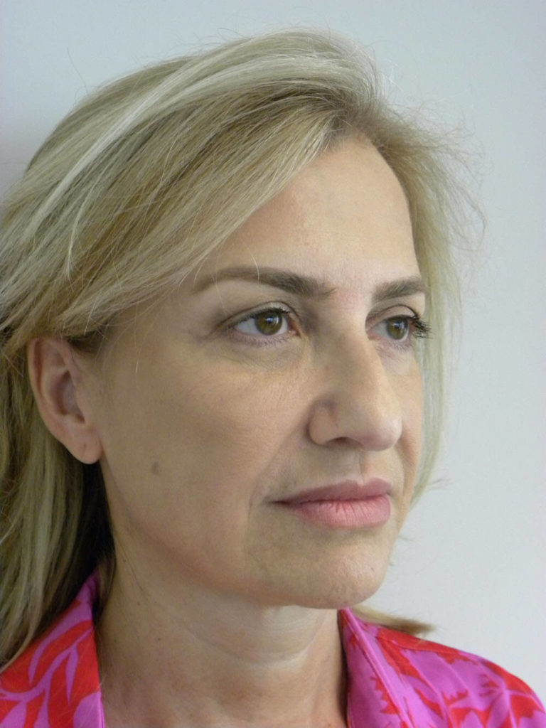 Facelift before and after - before