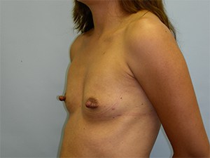 Breast Augmentation before and after - before