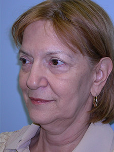 Facelift before and after - before