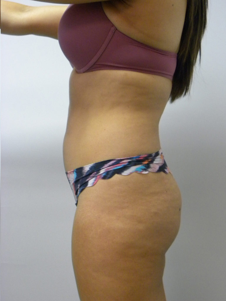 Liposuction before and after - before