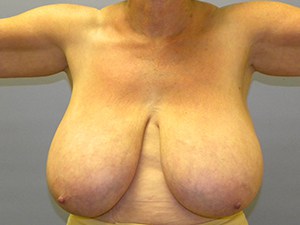 Breast Reduction before and after - before