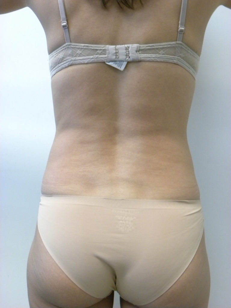 Liposuction before and after - before
