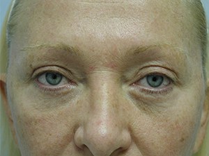 Facelift before and after - before