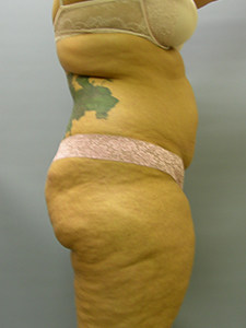 Liposuction before and after - before