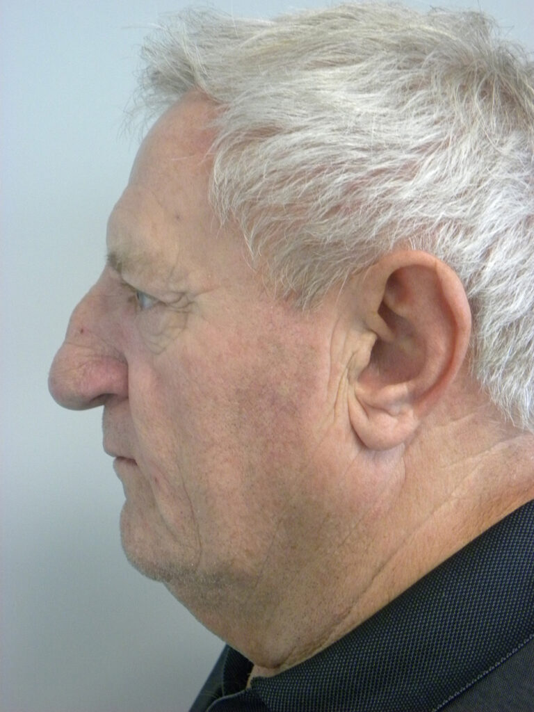Facelift before and after - before