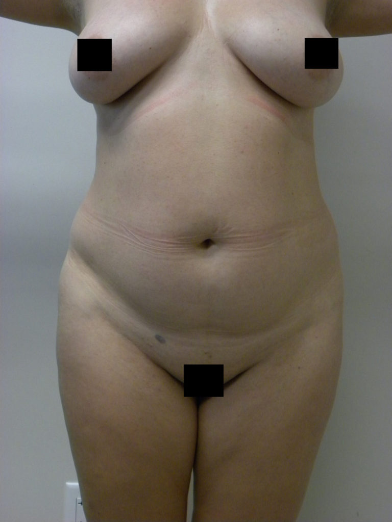 Liposuction before and after - before
