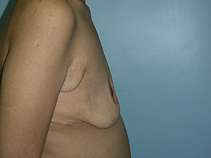 Breast Augmentation before and after - before