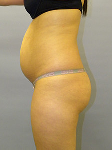 Liposuction before and after - before