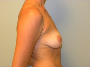 Breast Augmentation before and after - before