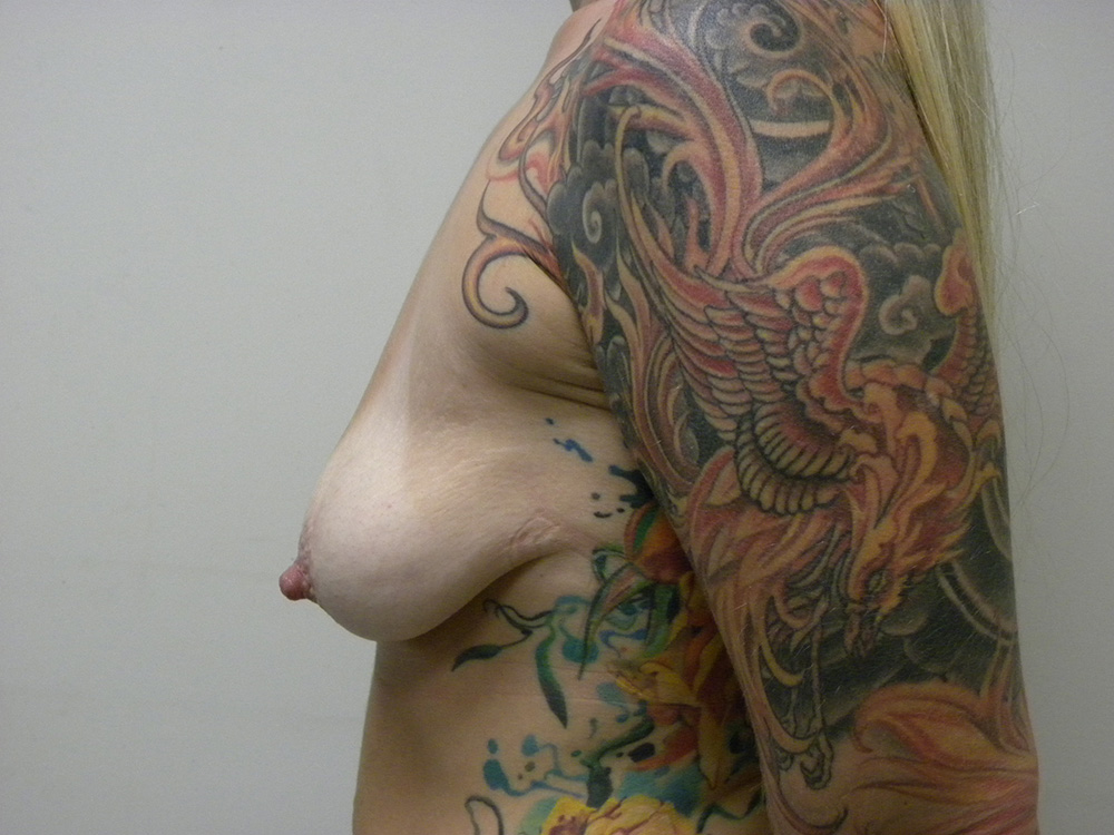 Breast Lift before and after - before