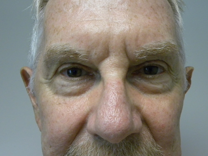 Blepharoplasty before and after - before