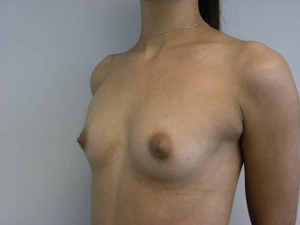 Breast Augmentation before and after - before