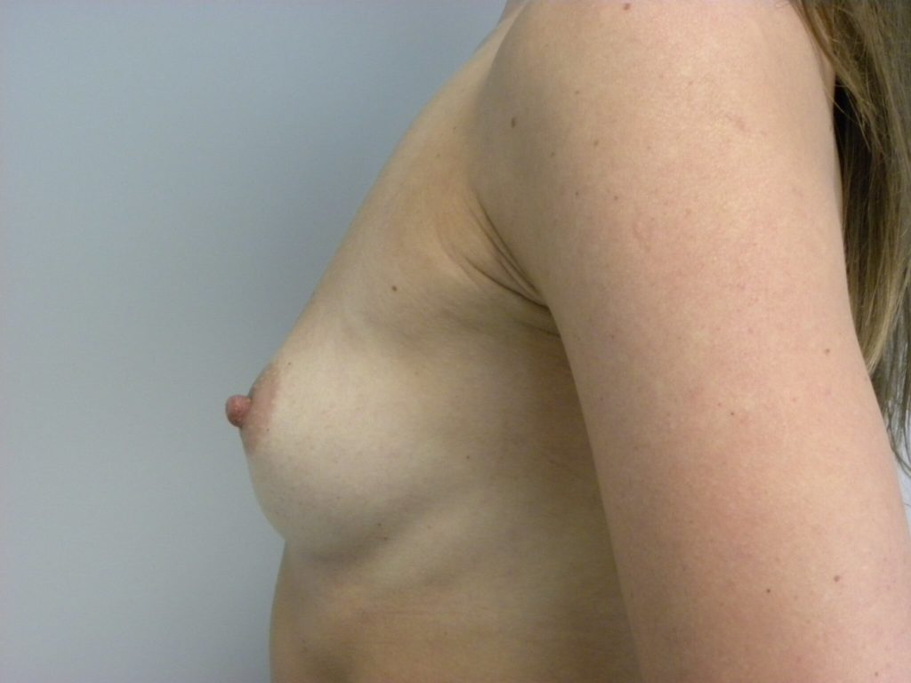Breast Augmentation before and after - before
