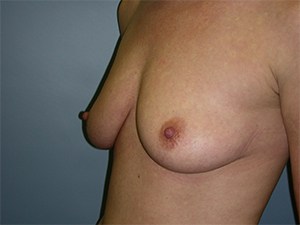 Breast Augmentation before and after - before
