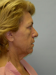 Facelift before and after - before
