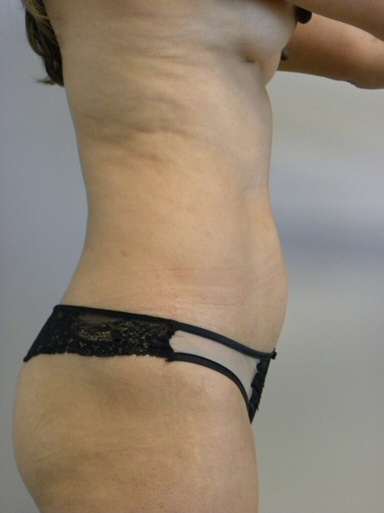 Liposuction before and after - before