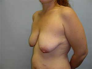 Breast Lift before and after - before