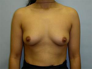 Breast Augmentation before and after - before
